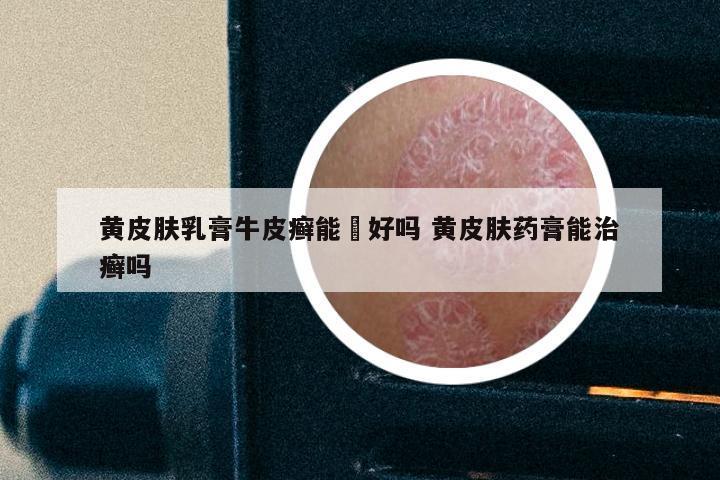 黄皮肤乳膏牛皮癣能抺好吗 黄皮肤药膏能治癣吗