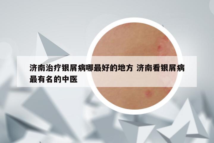 济南治疗银屑病哪最好的地方 济南看银屑病最有名的中医