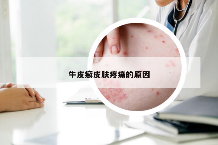 牛皮癣皮肤疼痛的原因