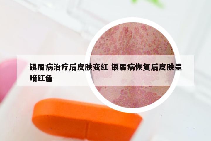 银屑病治疗后皮肤变红 银屑病恢复后皮肤呈暗红色