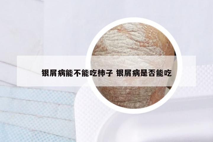 银屑病能不能吃柿子 银屑病是否能吃