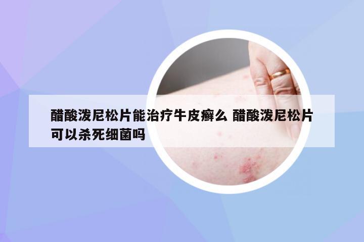 醋酸泼尼松片能治疗牛皮癣么 醋酸泼尼松片可以杀死细菌吗