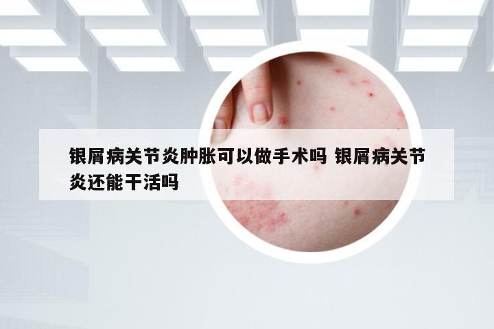 银屑病关节炎肿胀可以做手术吗 银屑病关节炎还能干活吗