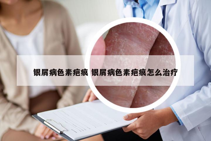 银屑病色素疤痕 银屑病色素疤痕怎么治疗