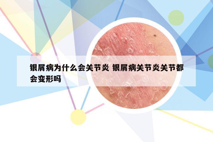 银屑病为什么会关节炎 银屑病关节炎关节都会变形吗