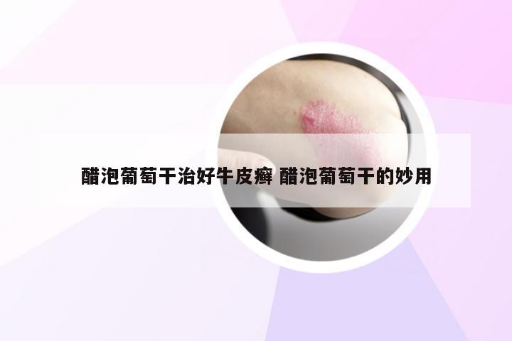 醋泡葡萄干治好牛皮癣 醋泡葡萄干的妙用