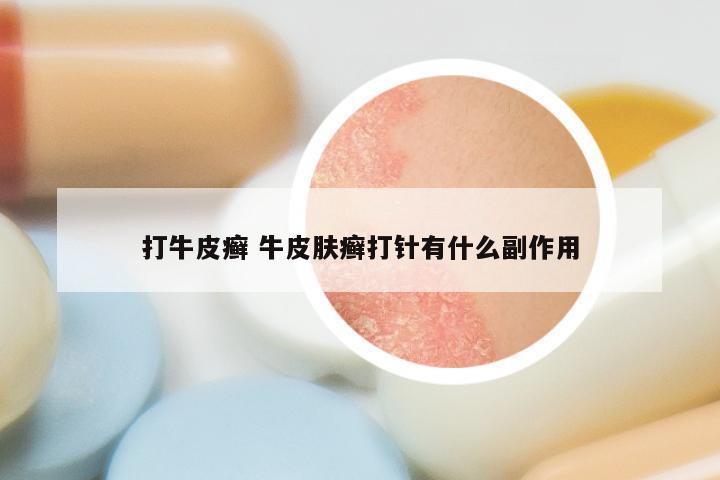 打牛皮癣 牛皮肤癣打针有什么副作用