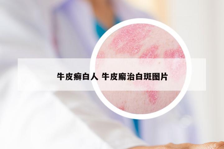 牛皮癣白人 牛皮廨治白斑图片