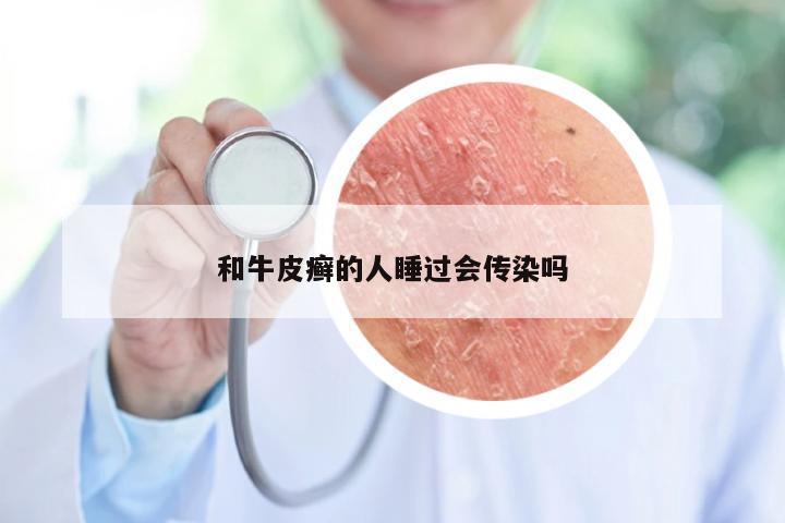 和牛皮癣的人睡过会传染吗