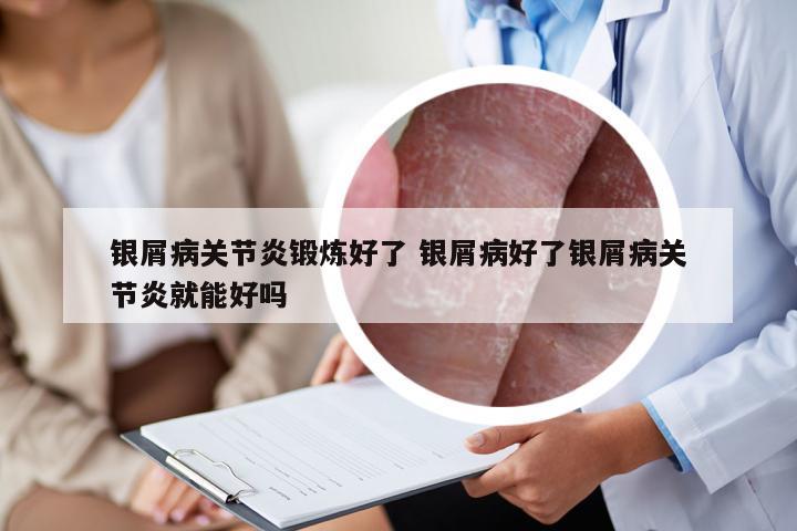 银屑病关节炎锻炼好了 银屑病好了银屑病关节炎就能好吗