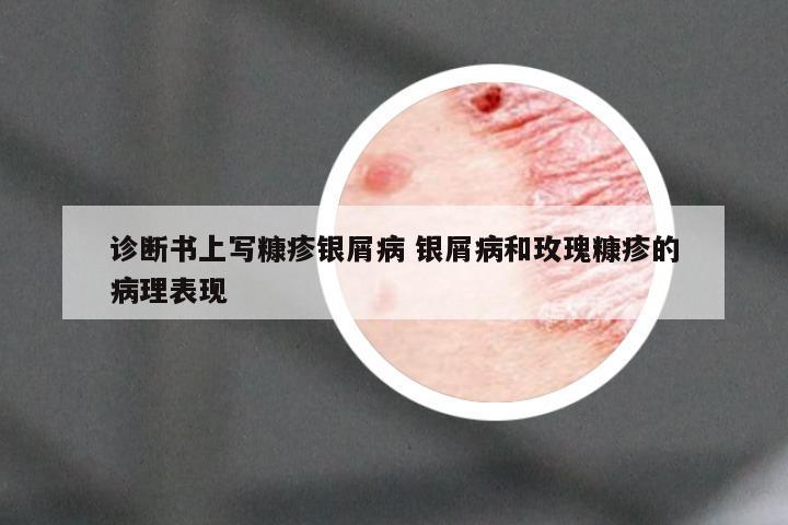 诊断书上写糠疹银屑病 银屑病和玫瑰糠疹的病理表现