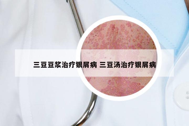 三豆豆浆治疗银屑病 三豆汤治疗银屑病