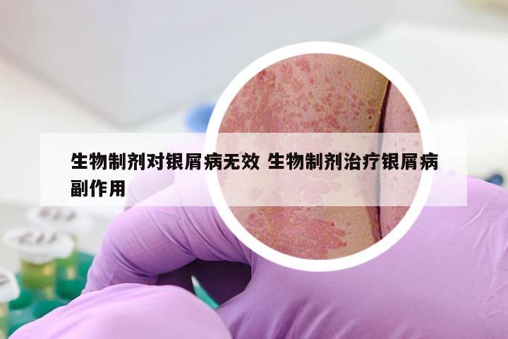 生物制剂对银屑病无效 生物制剂治疗银屑病副作用