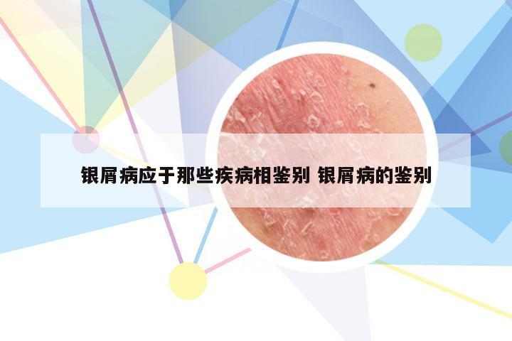 银屑病应于那些疾病相鉴别 银屑病的鉴别