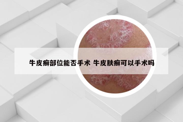 牛皮癣部位能否手术 牛皮肤癣可以手术吗