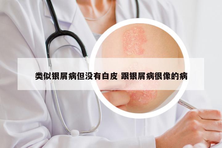 类似银屑病但没有白皮 跟银屑病很像的病