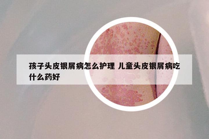 孩子头皮银屑病怎么护理 儿童头皮银屑病吃什么药好