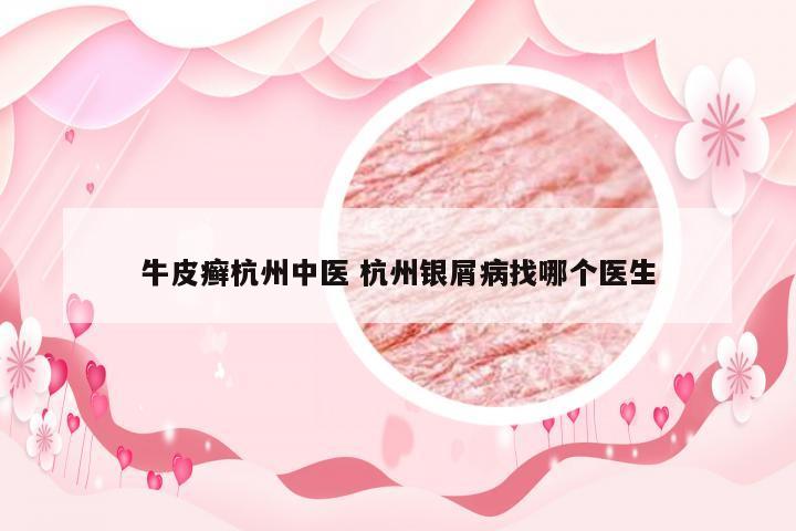 牛皮癣杭州中医 杭州银屑病找哪个医生