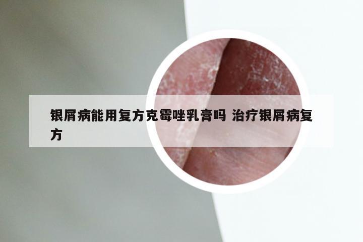 银屑病能用复方克霉唑乳膏吗 治疗银屑病复方