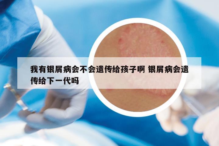 我有银屑病会不会遗传给孩子啊 银屑病会遗传给下一代吗