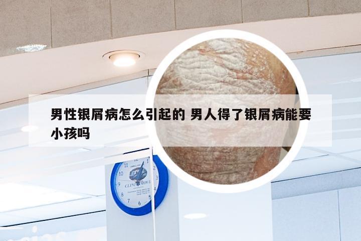 男性银屑病怎么引起的 男人得了银屑病能要小孩吗
