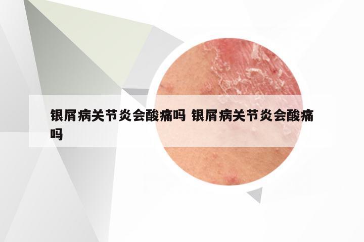 银屑病关节炎会酸痛吗 银屑病关节炎会酸痛吗