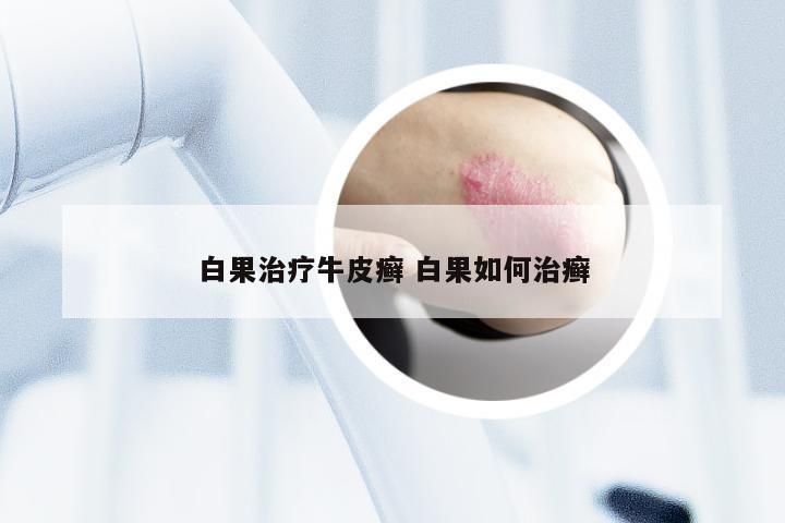 白果治疗牛皮癣 白果如何治癣