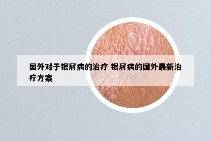 国外对于银屑病的治疗 银屑病的国外最新治疗方案