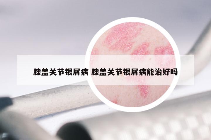 膝盖关节银屑病 膝盖关节银屑病能治好吗