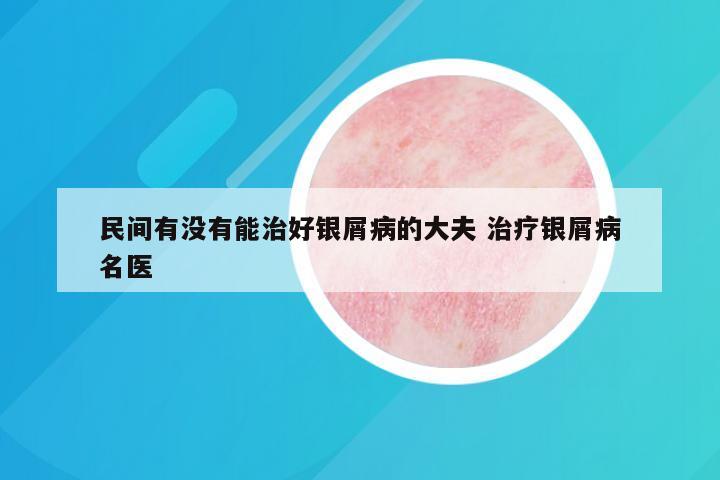 民间有没有能治好银屑病的大夫 治疗银屑病名医
