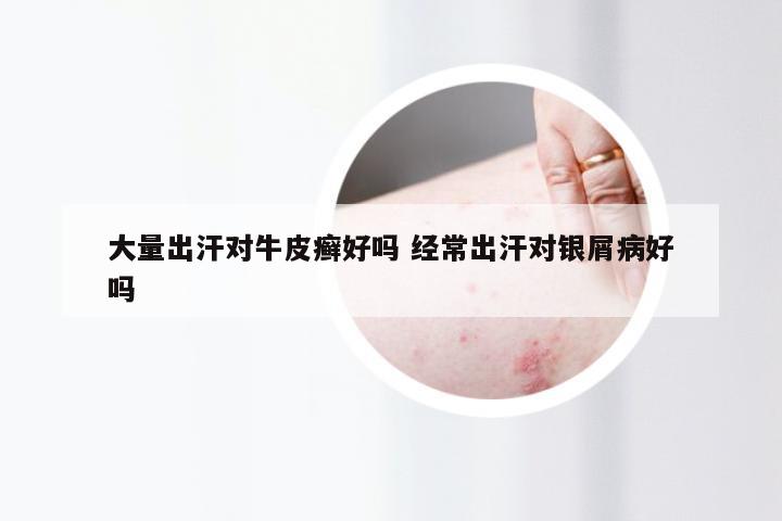 大量出汗对牛皮癣好吗 经常出汗对银屑病好吗