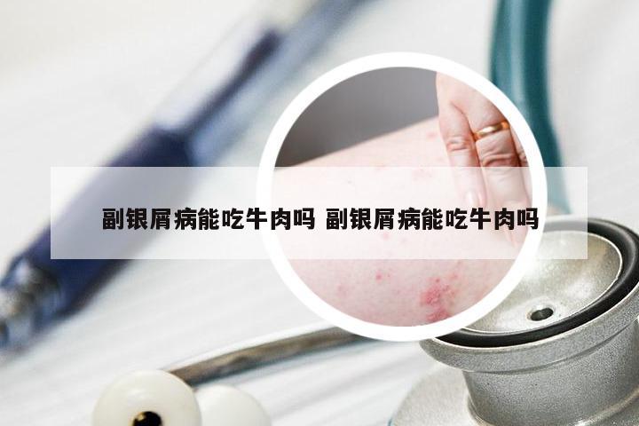 副银屑病能吃牛肉吗 副银屑病能吃牛肉吗