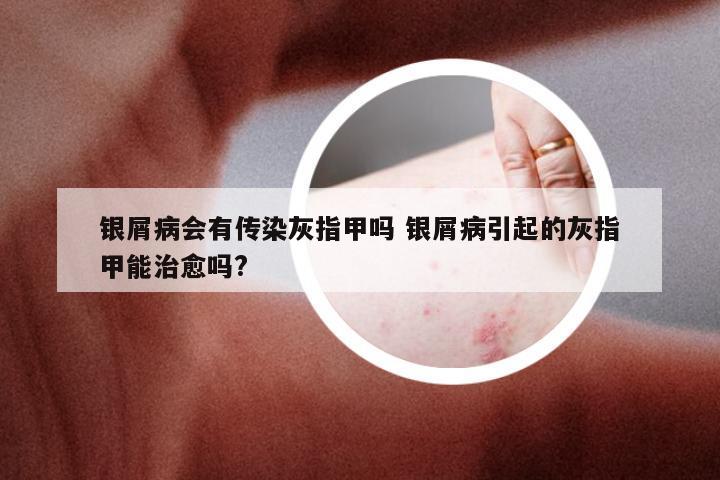 银屑病会有传染灰指甲吗 银屑病引起的灰指甲能治愈吗?
