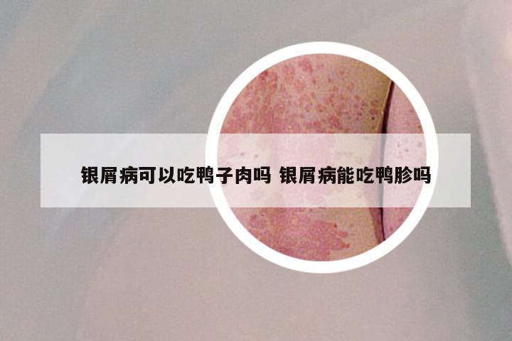 银屑病可以吃鸭子肉吗 银屑病能吃鸭胗吗