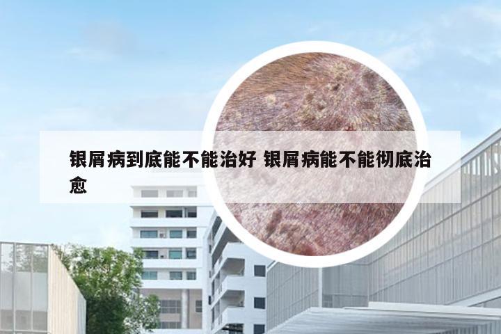 银屑病到底能不能治好 银屑病能不能彻底治愈