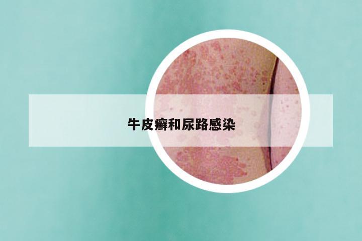 牛皮癣和尿路感染