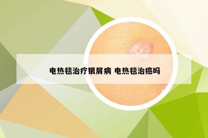 电热毯治疗银屑病 电热毯治癌吗