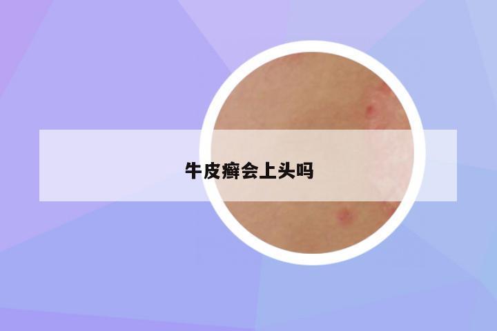 牛皮癣会上头吗