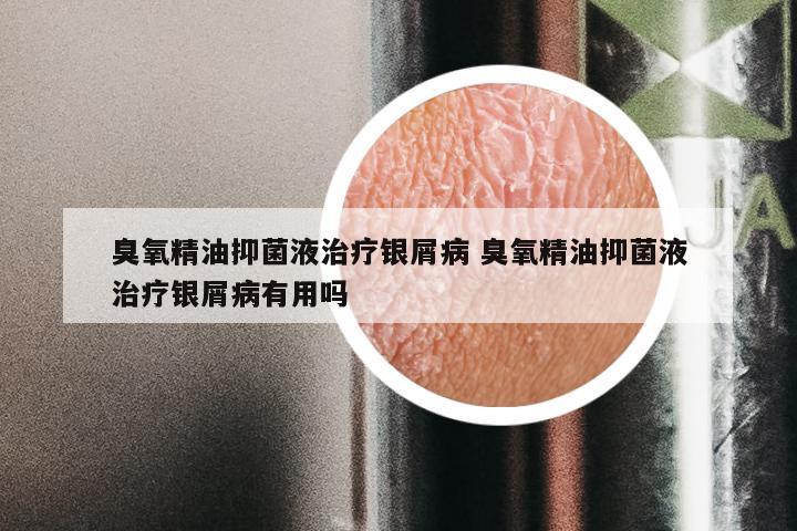 臭氧精油抑菌液治疗银屑病 臭氧精油抑菌液治疗银屑病有用吗