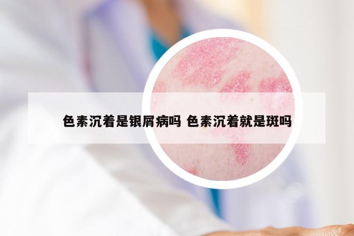 色素沉着是银屑病吗 色素沉着就是斑吗