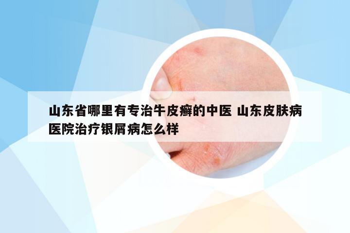 山东省哪里有专治牛皮癣的中医 山东皮肤病医院治疗银屑病怎么样