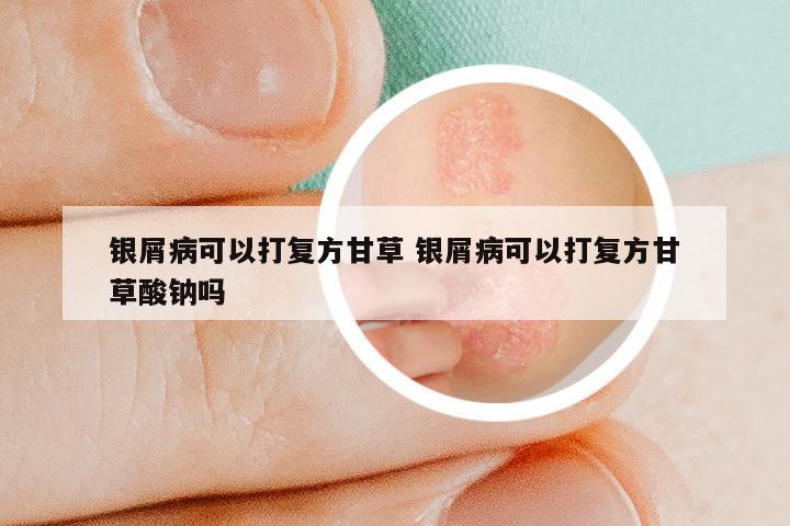 银屑病可以打复方甘草 银屑病可以打复方甘草酸钠吗