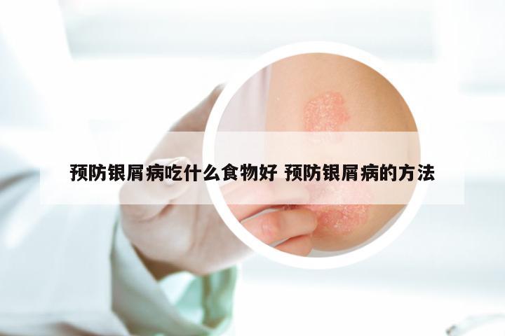预防银屑病吃什么食物好 预防银屑病的方法