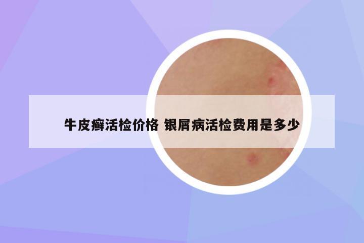 牛皮癣活检价格 银屑病活检费用是多少
