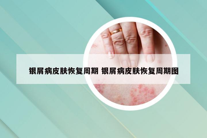银屑病皮肤恢复周期 银屑病皮肤恢复周期图