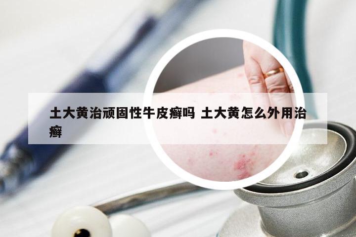 土大黄治顽固性牛皮癣吗 土大黄怎么外用治癣