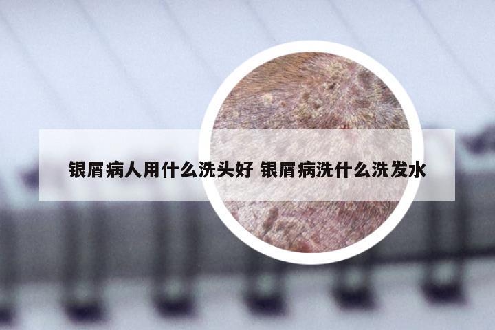 银屑病人用什么洗头好 银屑病洗什么洗发水