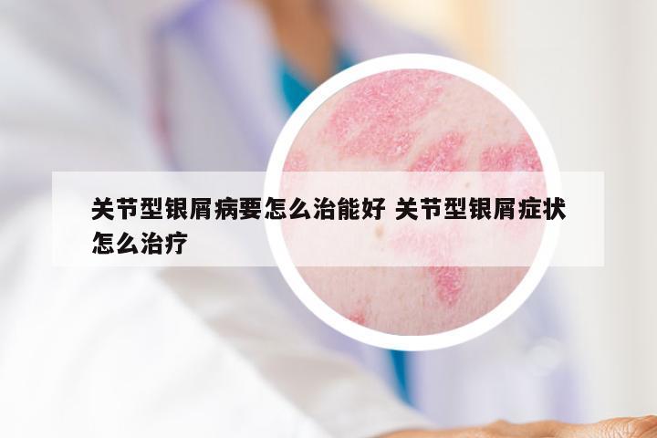 关节型银屑病要怎么治能好 关节型银屑症状怎么治疗