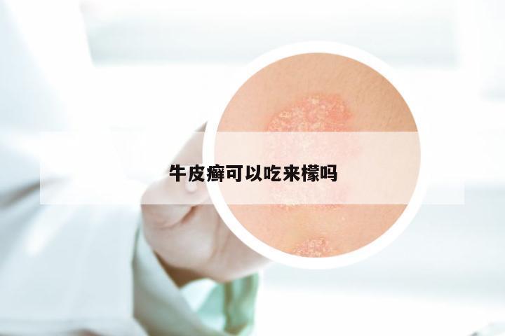 牛皮癣可以吃来檬吗