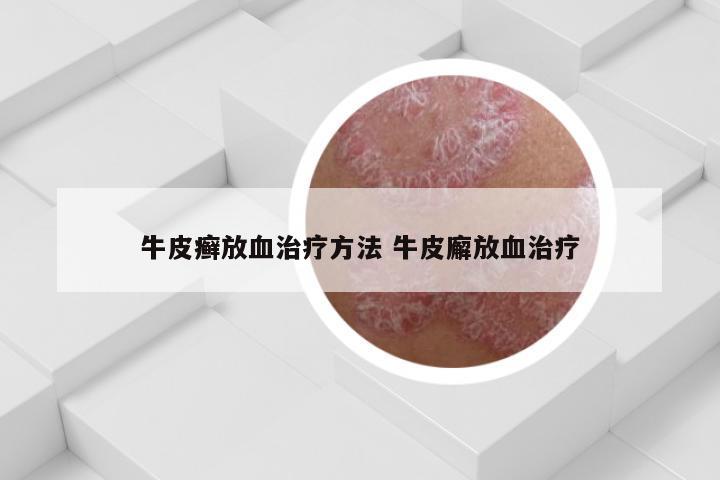 牛皮癣放血治疗方法 牛皮廨放血治疗